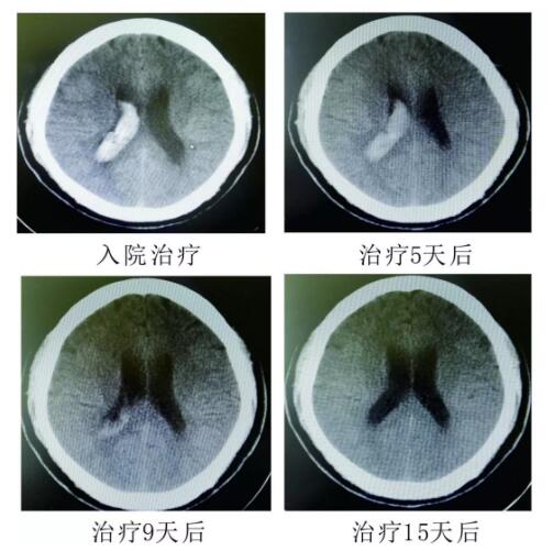 腦出血你不得不引起重視的疾?。。?！