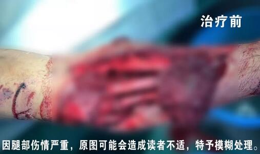 感謝安利醫(yī)院挽救了我的腿，沒有讓我落下殘疾……”