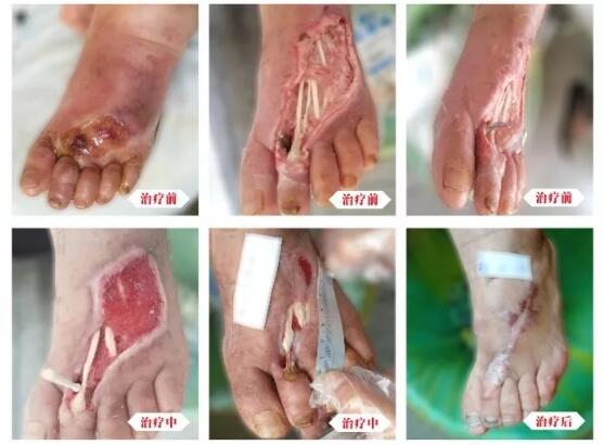 糖尿病并發(fā)癥有多可怕，及時治療糖尿病足避免截肢！