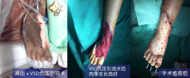 車禍猛如虎，救治如“華佗” ，手術(shù)＋康復(fù)，8歲小女孩車禍后日漸康復(fù)行走