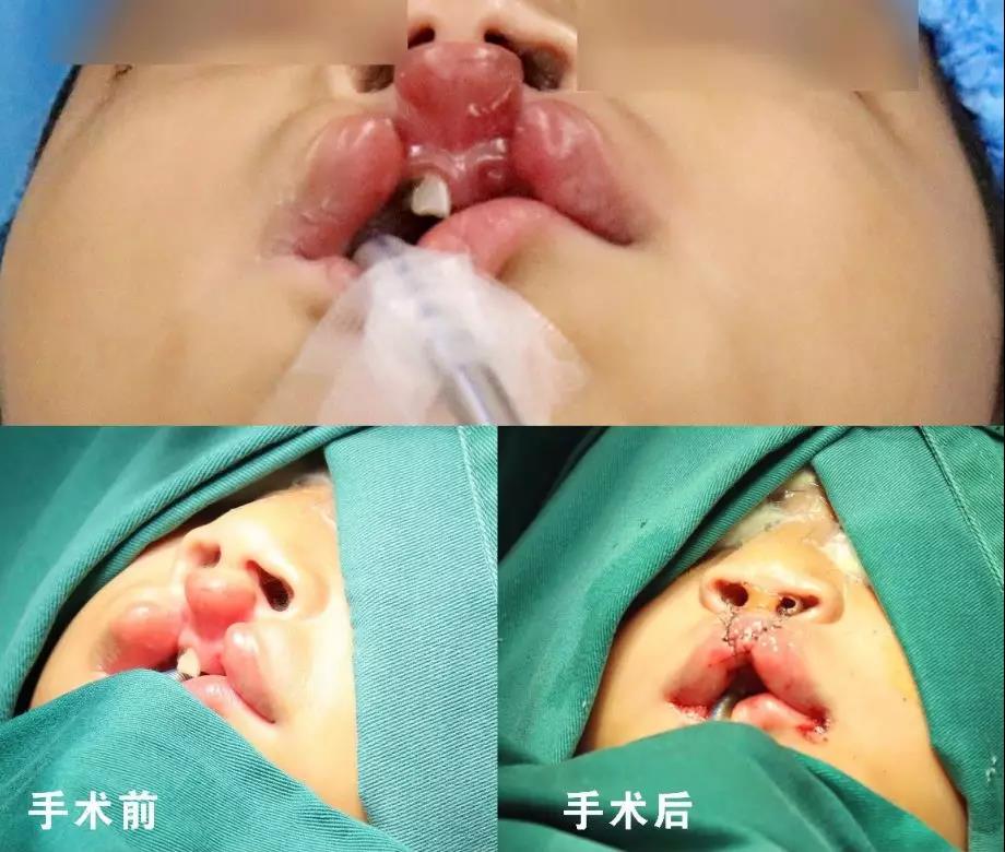 唇腭裂盡早治療消除孩子自卑心理，快樂(lè)成長(zhǎng)！
