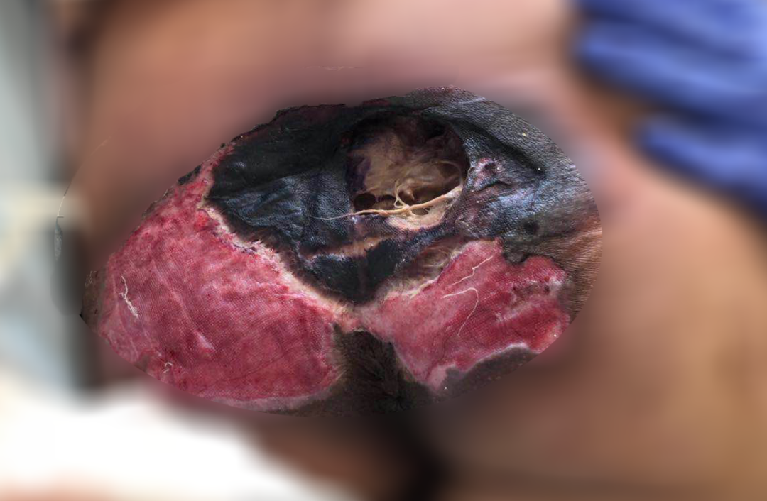癱瘓3年的女患者臀部居然變成這樣?！