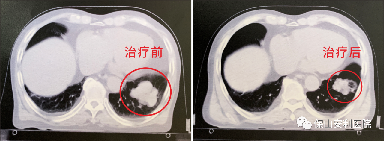不做手術(shù)，早期肺癌也能根治！