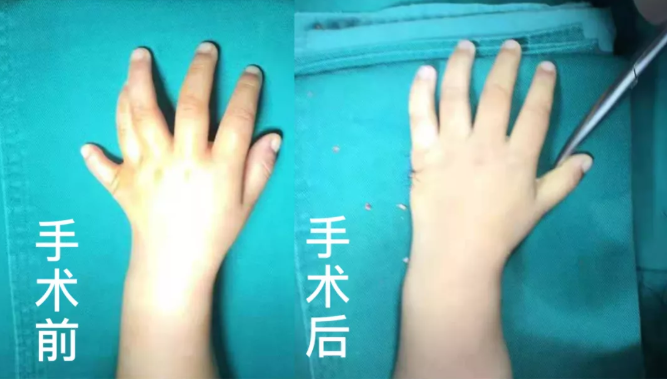 【保山安利醫(yī)院】2歲小兒手、足多指（趾）成功修復(fù)(矯正）！