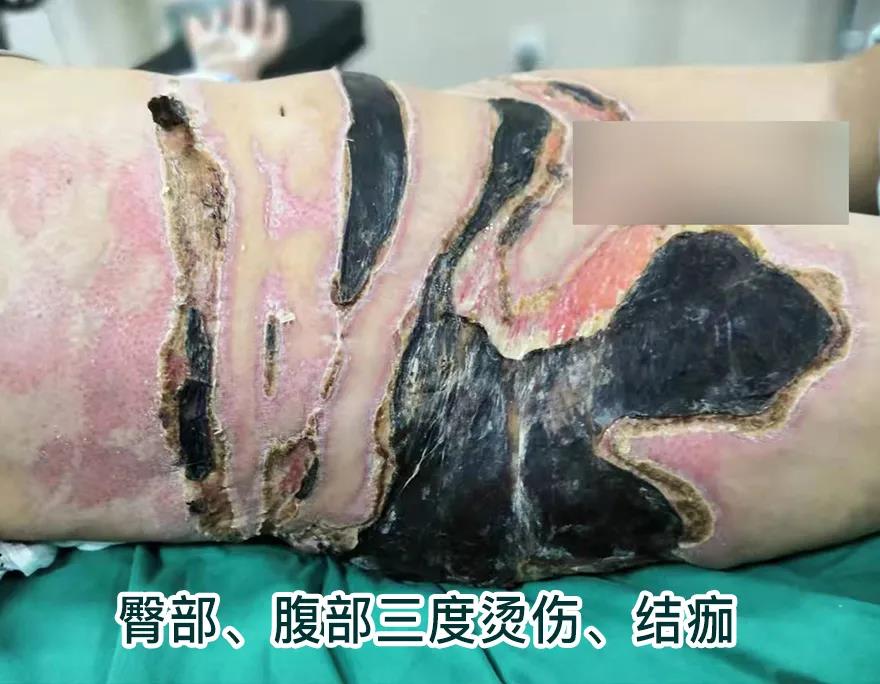 【保山安利醫(yī)院】80歲老人不慎燒傷，導(dǎo)致腹部、右側(cè)臀部大面積創(chuàng)傷，經(jīng)植皮治療創(chuàng)面逐漸愈合