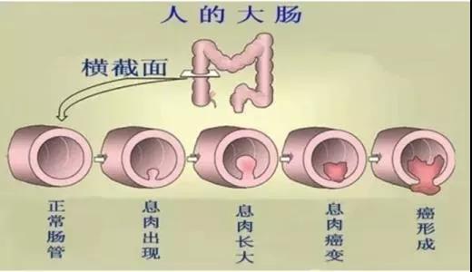 體檢發(fā)現(xiàn)腸息肉會癌變嗎？