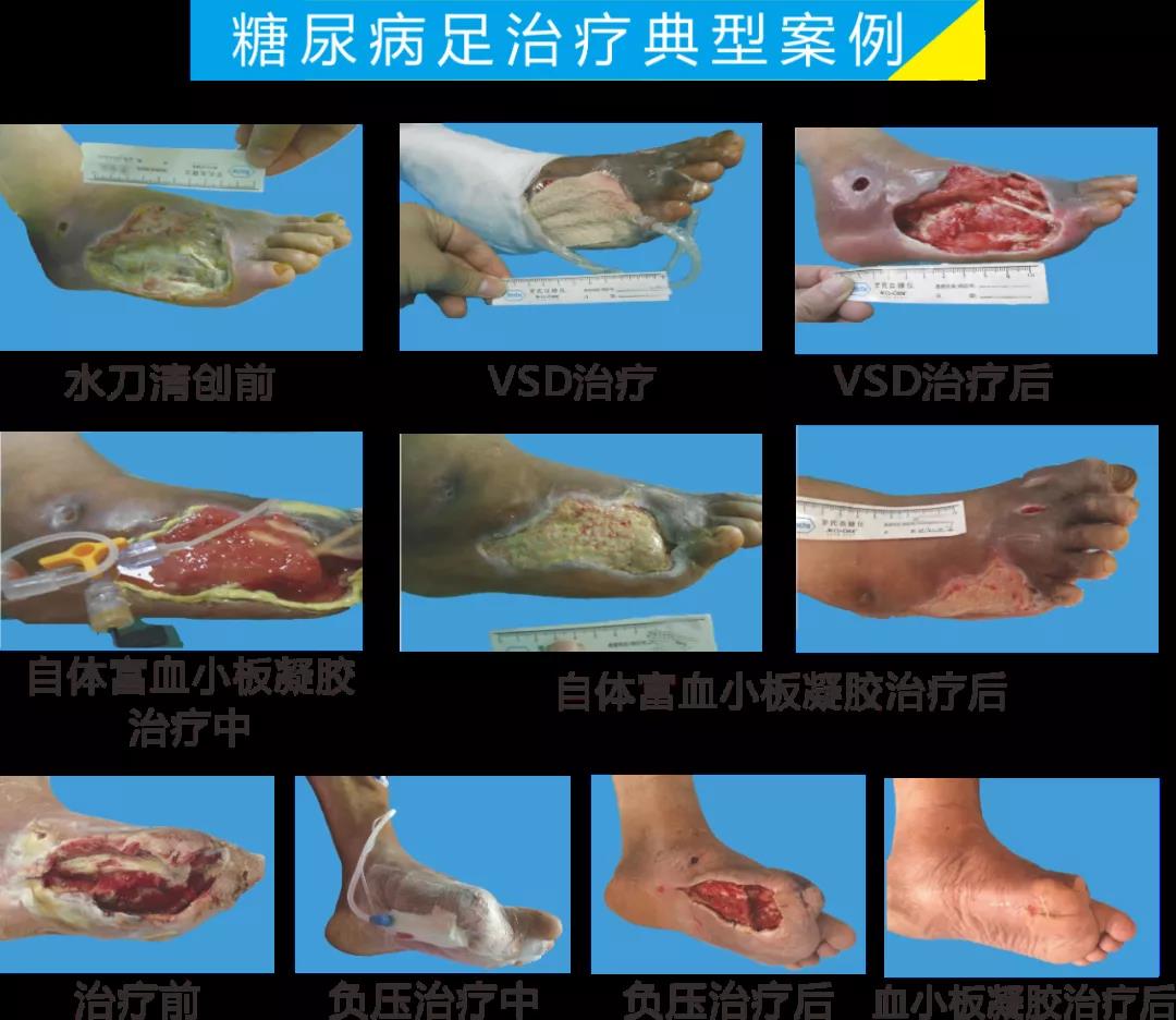 截肢、失明，甚至……，我們要做的是將糖尿病并發(fā)癥遏制在搖籃里！