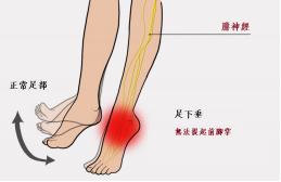 【保山安利醫(yī)院—健康科普】什么是足下垂！你了解嗎？