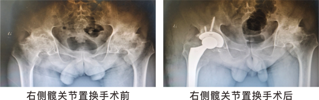 【保山安利醫(yī)院】長期飲酒導(dǎo)致雙側(cè)股骨頭壞死，髖關(guān)節(jié)置換后重獲運(yùn)動功能！