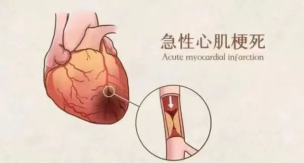 【保山安利醫(yī)院】11月20日“心梗救治日” 時間就是心肌，時間就是生命！